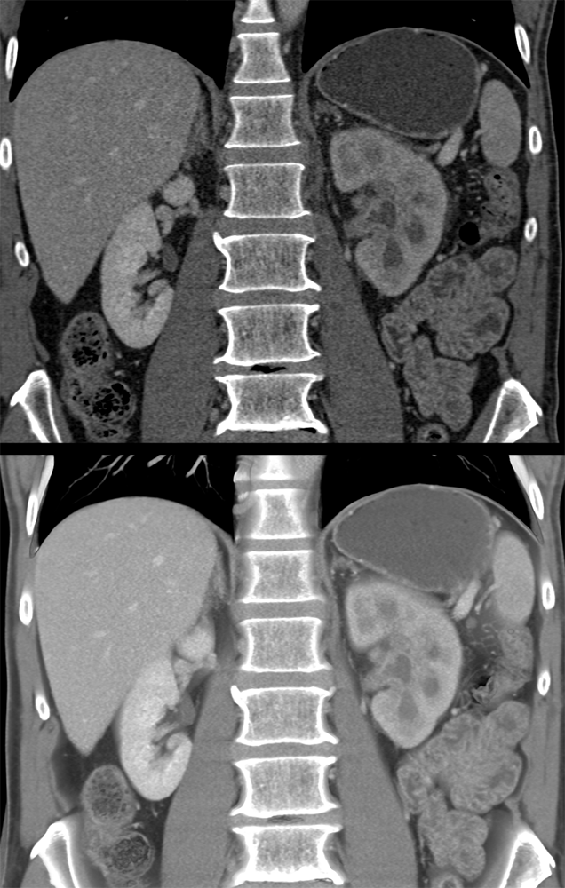 Transitional Cell Carcinoma of the Kidneys