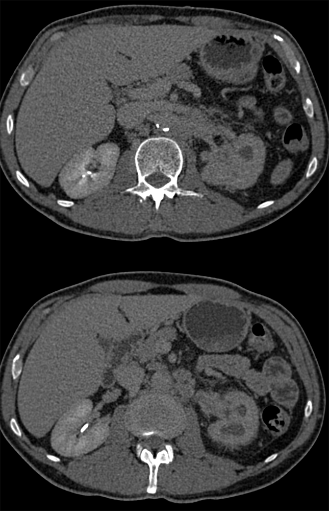 Transitional Cell Carcinoma of the Kidneys