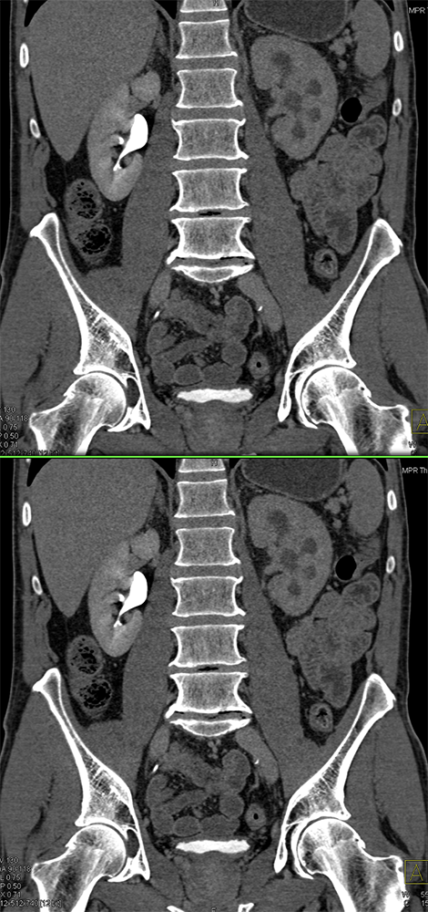 Transitional Cell Carcinoma of the Kidneys