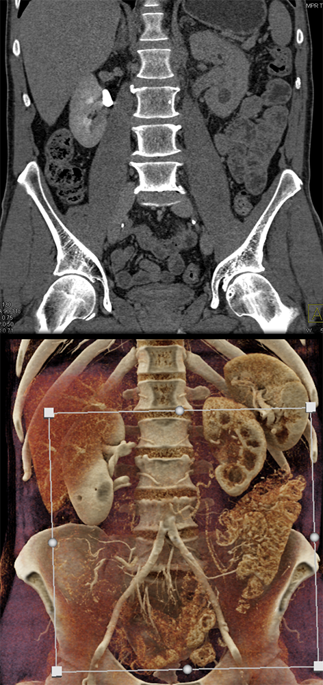 Transitional Cell Carcinoma of the Kidneys