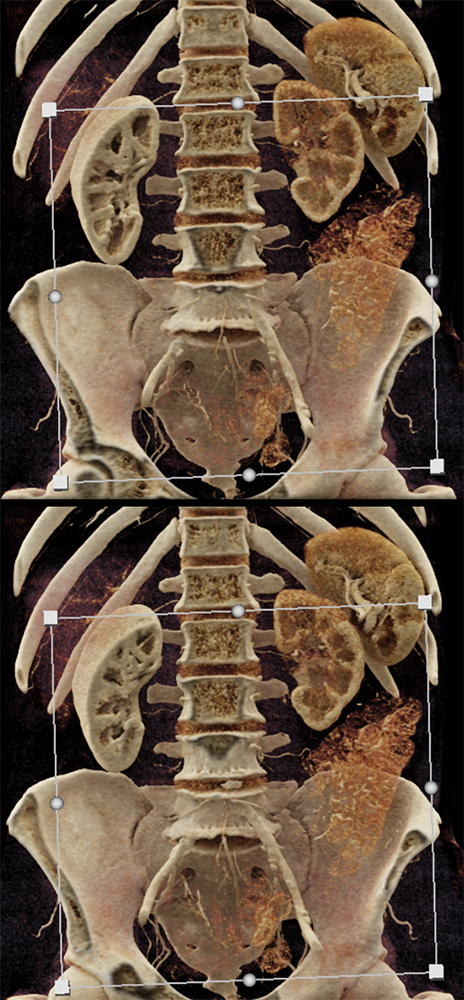 Transitional Cell Carcinoma of the Kidneys