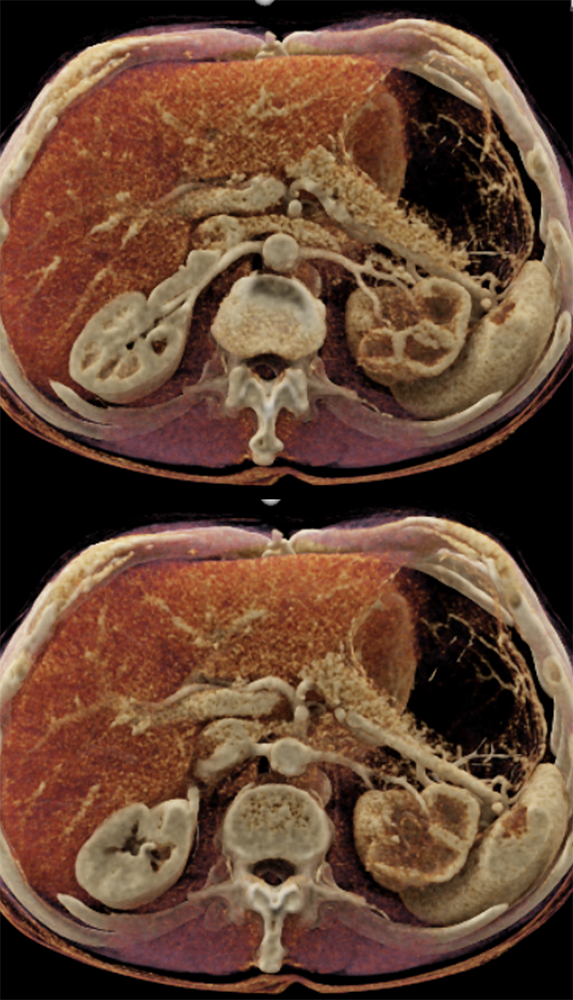 Transitional Cell Carcinoma of the Kidneys