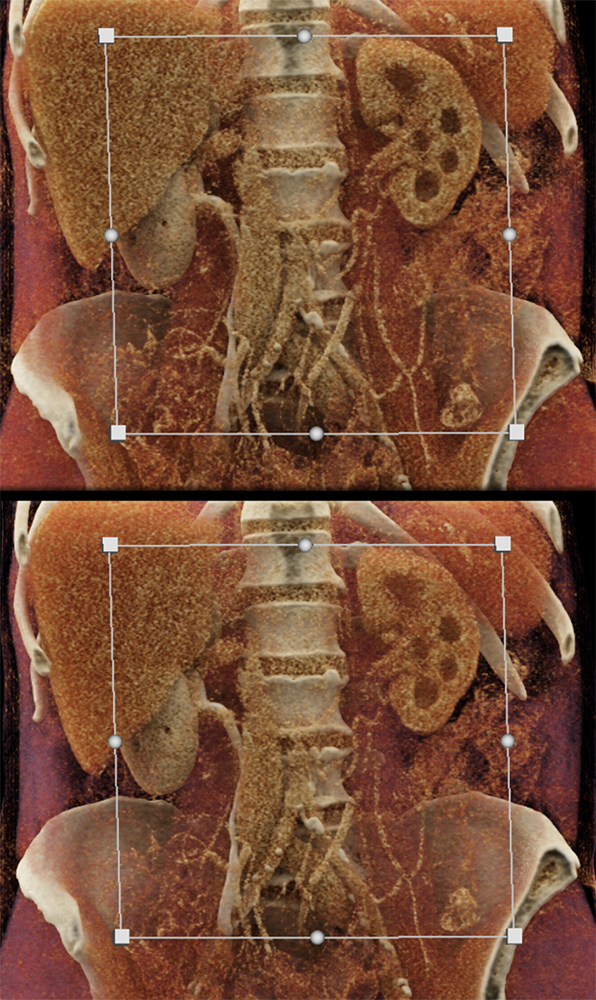 Transitional Cell Carcinoma of the Kidneys