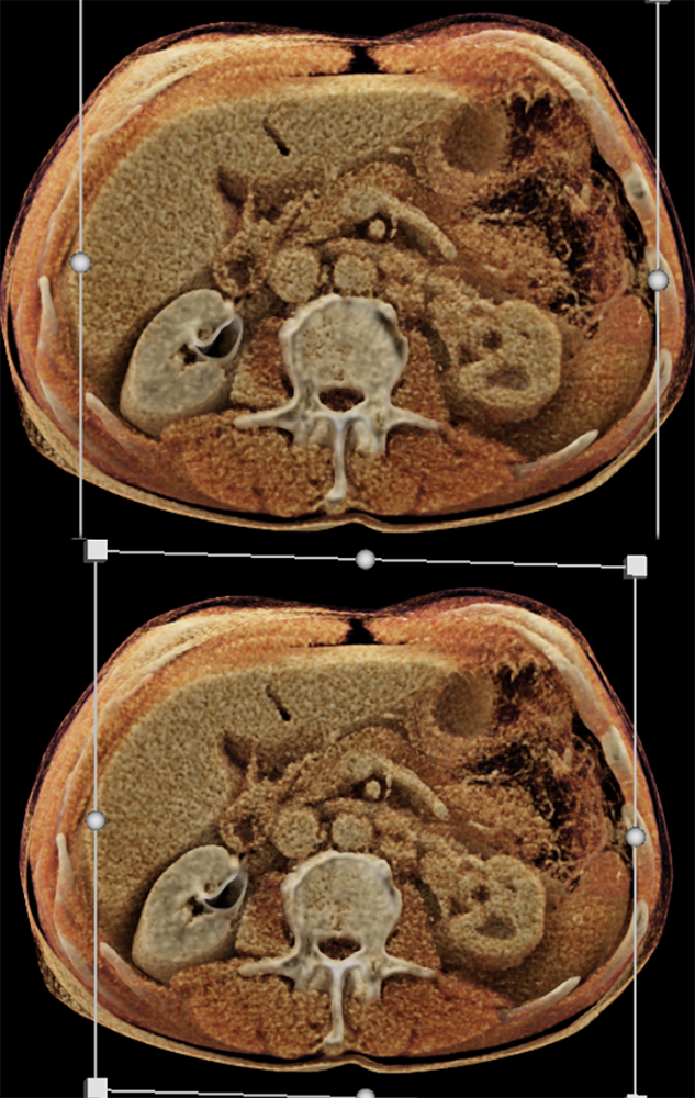 Transitional Cell Carcinoma of the Kidneys