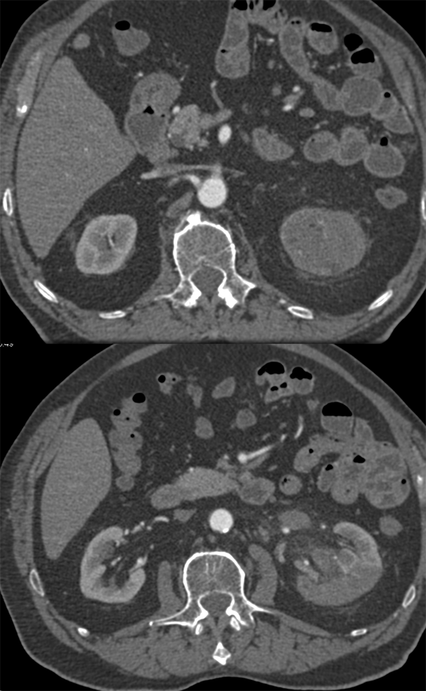 TCC Kidney Invades the Renal Vein