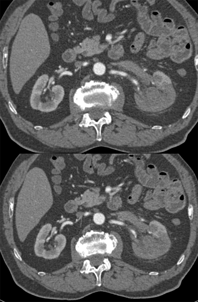 Transitional Cell Carcinoma of the Kidneys