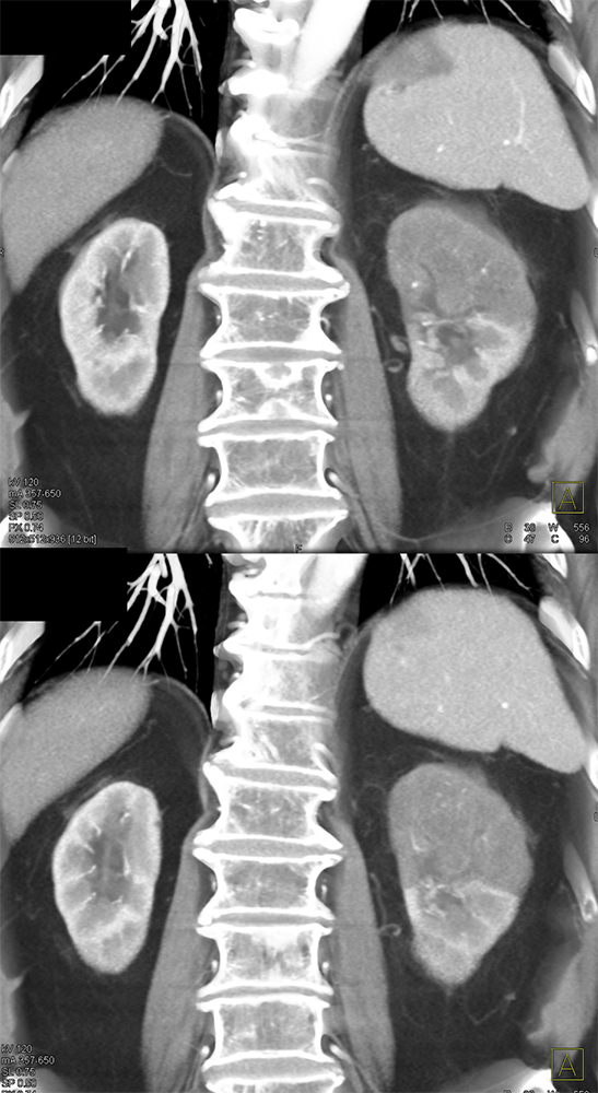 Transitional Cell Carcinoma of the Kidneys