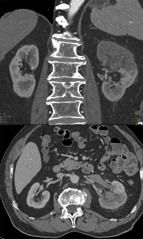 Transitional Cell Carcinoma of the Kidneys