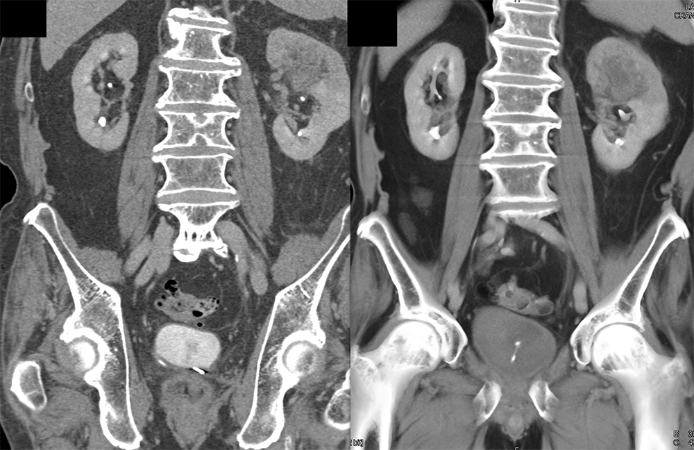 Transitional Cell Carcinoma of the Kidneys