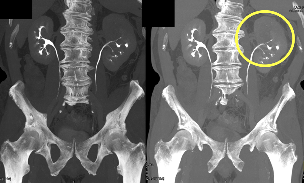 Transitional Cell Carcinoma of the Kidneys