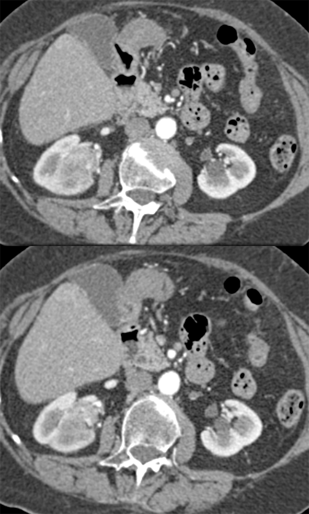 Transitional Cell Carcinoma