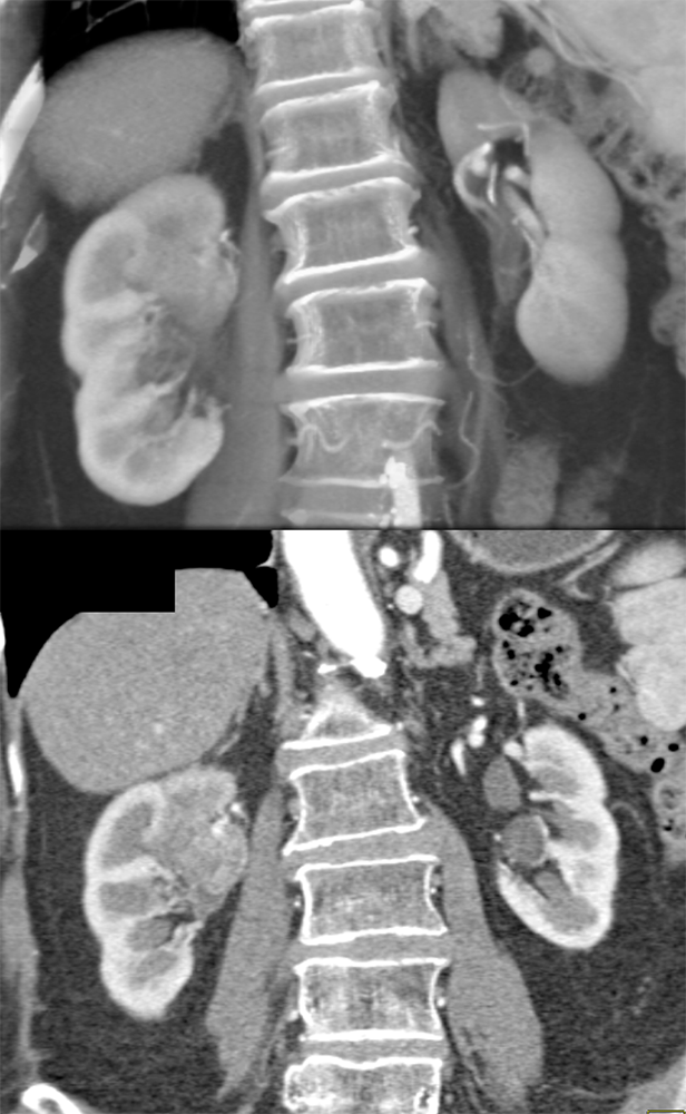 Transitional Cell Carcinoma of the Kidneys