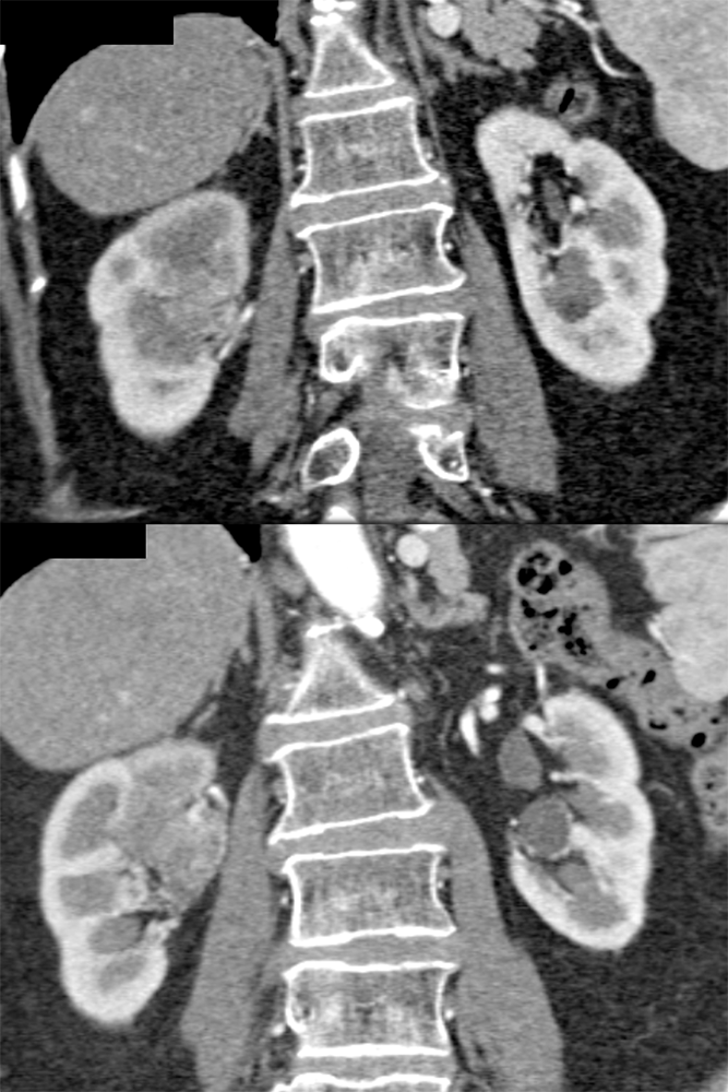 Transitional Cell Carcinoma of the Kidneys