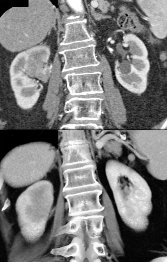 Transitional Cell Carcinoma of the Kidneys