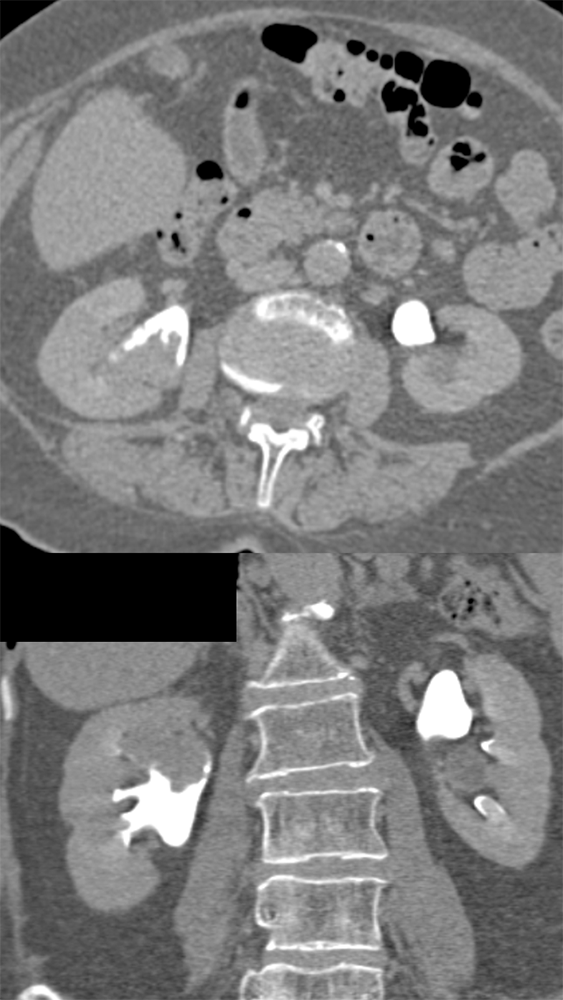 Transitional Cell Carcinoma of the Kidneys