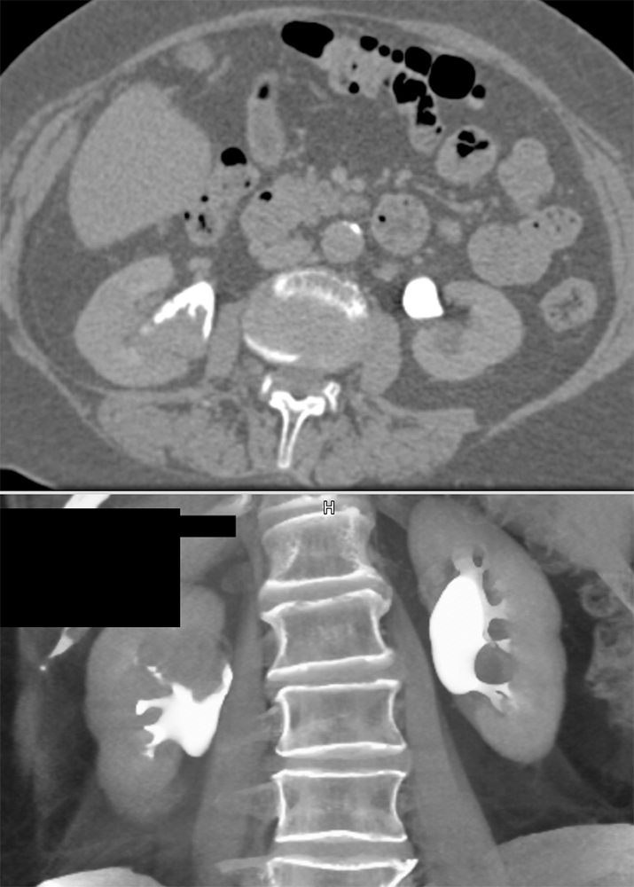 Transitional Cell Carcinoma of the Kidneys