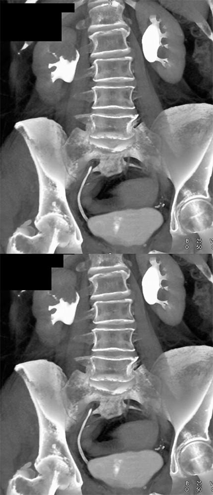 Transitional Cell Carcinoma of the Kidneys