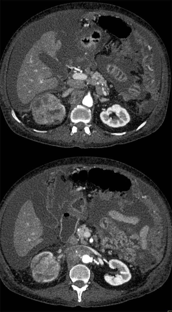 TCC Right Kidney