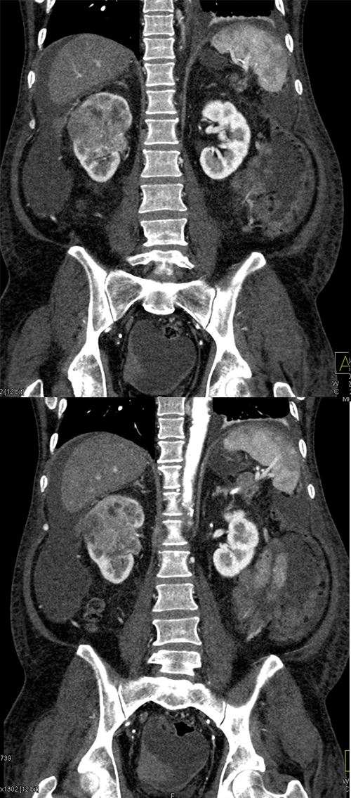 Transitional Cell Carcinoma of the Kidneys