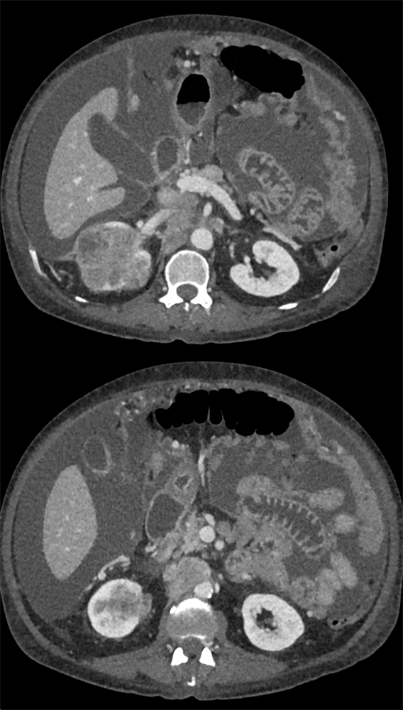 Transitional Cell Carcinoma of the Kidneys