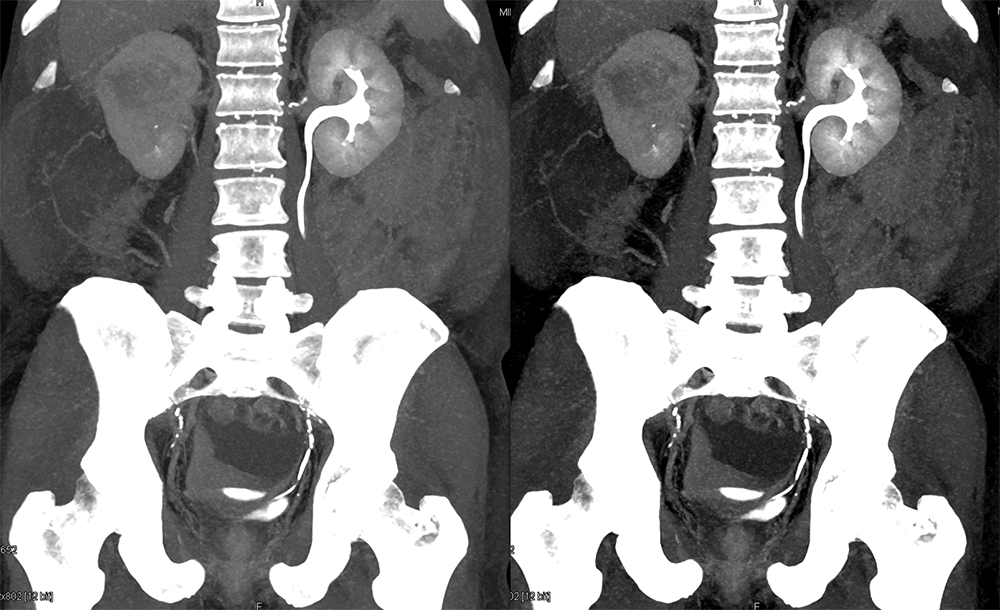 Transitional Cell Carcinoma of the Kidneys