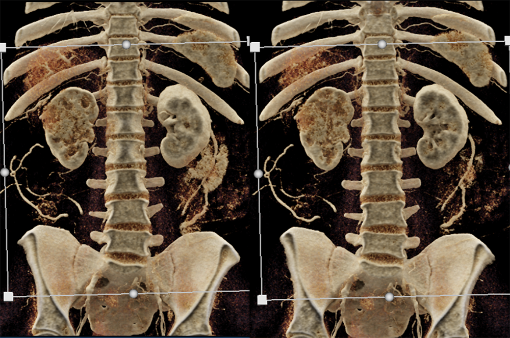 Transitional Cell Carcinoma of the Kidneys