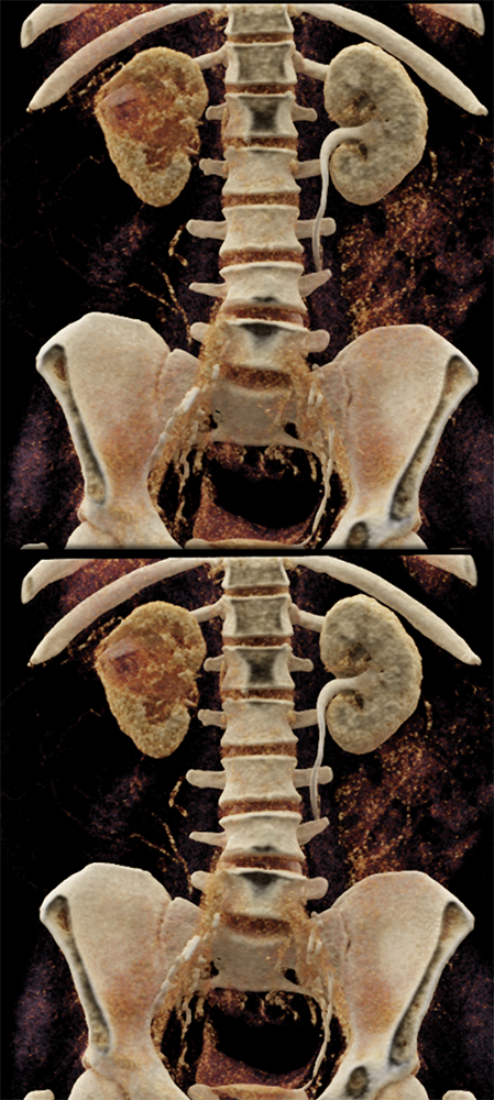 Transitional Cell Carcinoma of the Kidneys