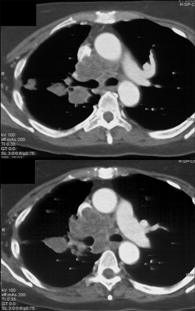 Metastatic Renal Cell Carcinoma Invades the Airway