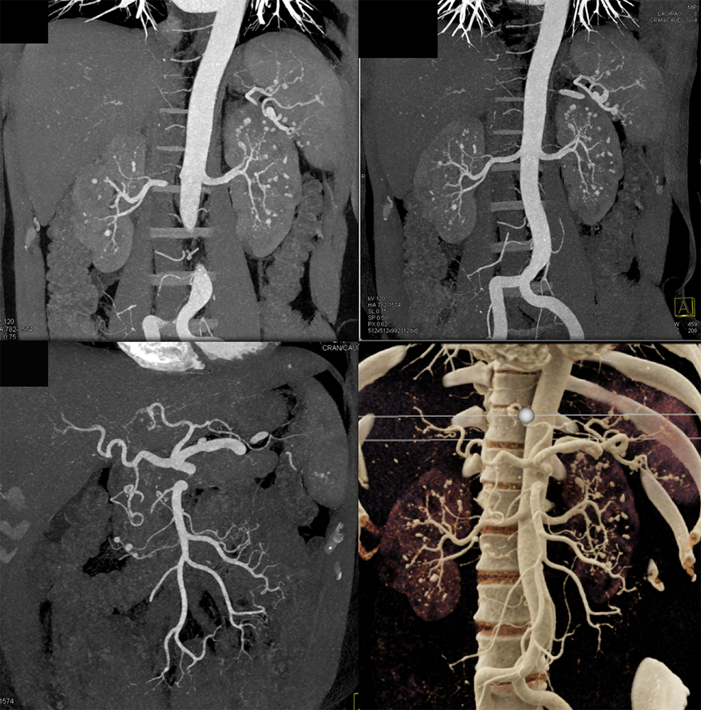 Clinical Presentation FUO and Hematuria