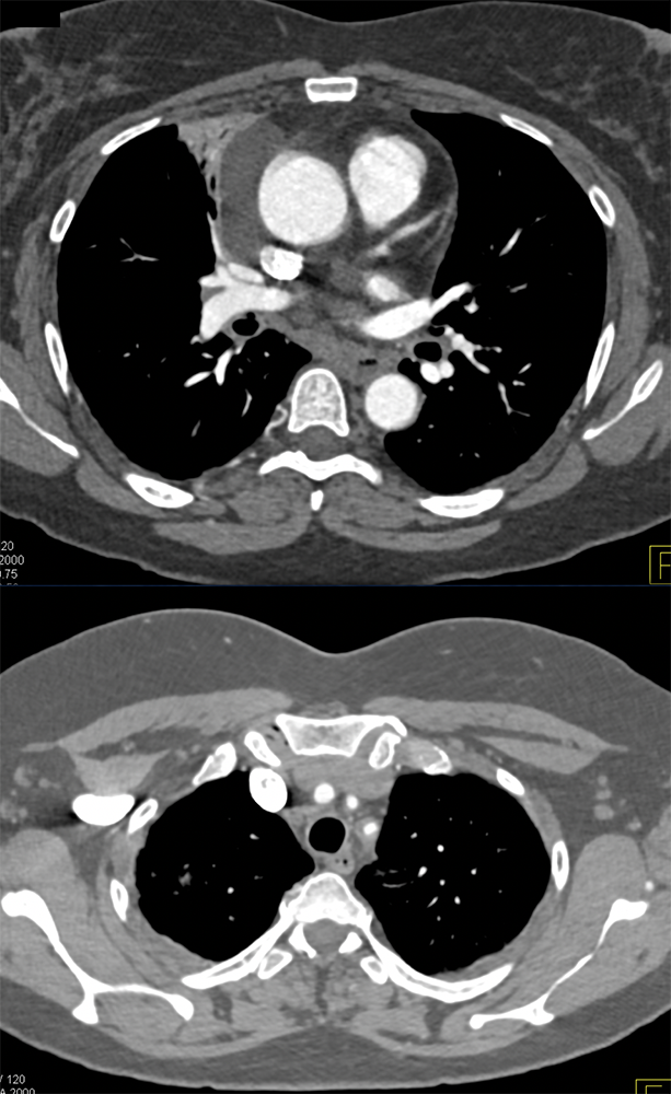 Takayasu’s Aortitis and Incidental Pericardial Cyst