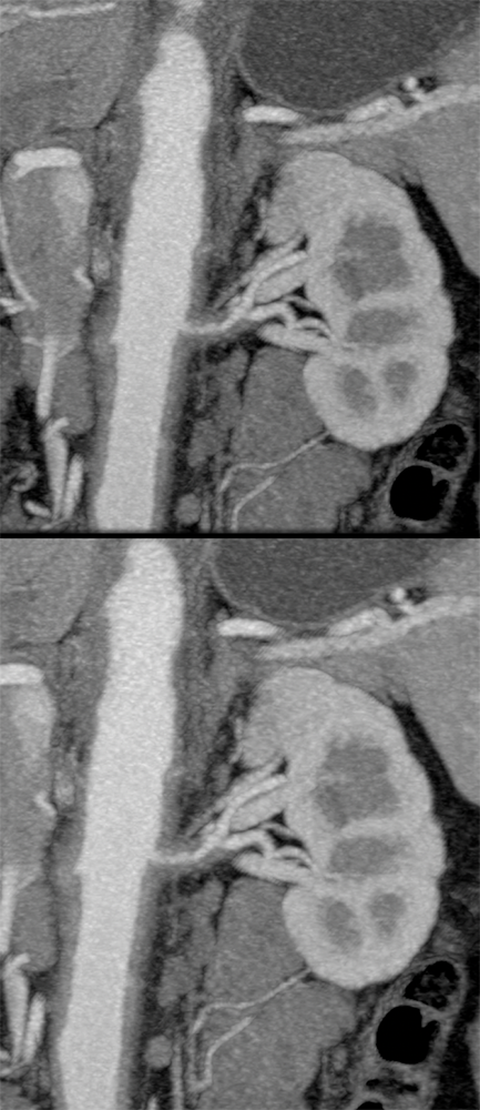Takayasu’s Aortitis: Renal Artery Involvement