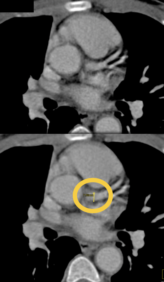 Takayasu’s Aortitis with Left Main Coronary Artery Aneurysm