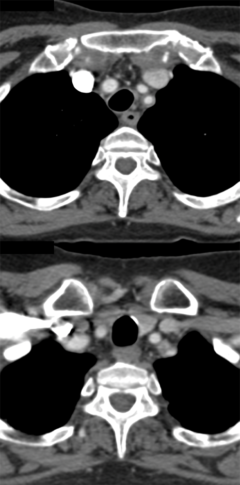 Giant Cell Arteritis from Temporal Artery Bx