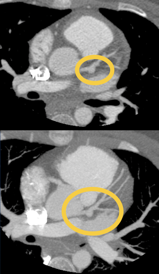 8 mm Aneurysm of the Left Main Coronary Artery