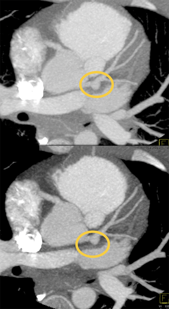 CT of Vasculitis