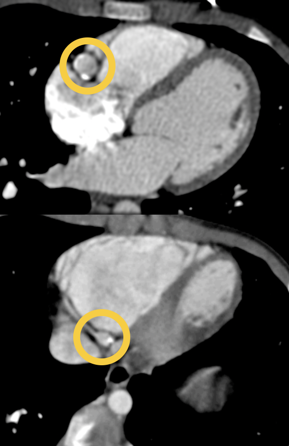 Kawasaki Disease with Giant Coronary Artery Aneurysms