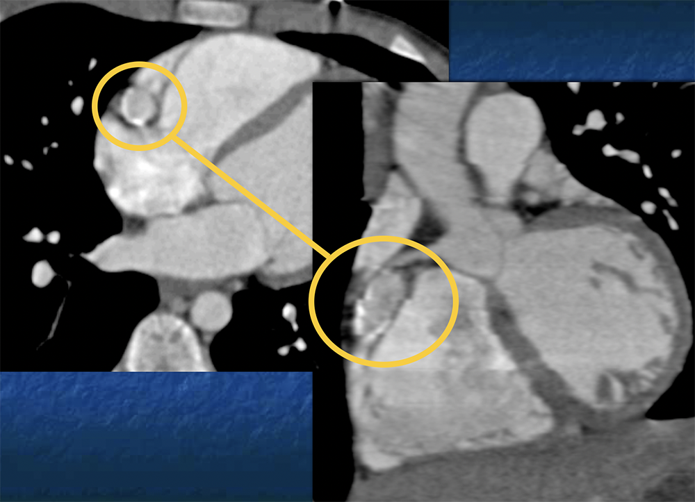 CT of Vasculitis