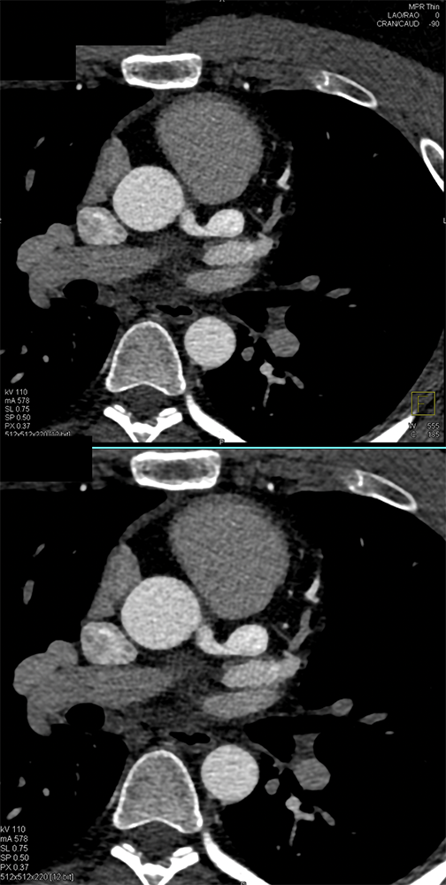 CCoronary Artery Aneurysm in Kawasaki’s Disease