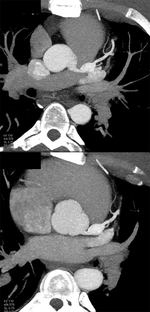 Coronary Artery Aneurysm in Kawasaki’s Disease