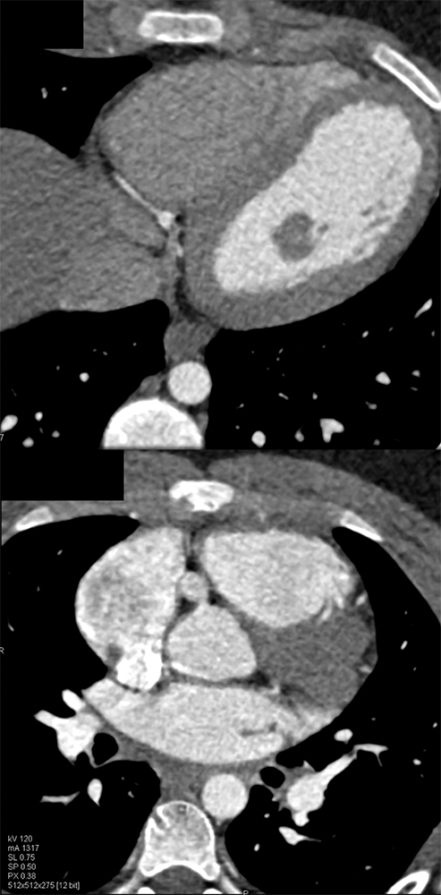 Kawasaki’s with Multiple Coronary Artery Aneurysms