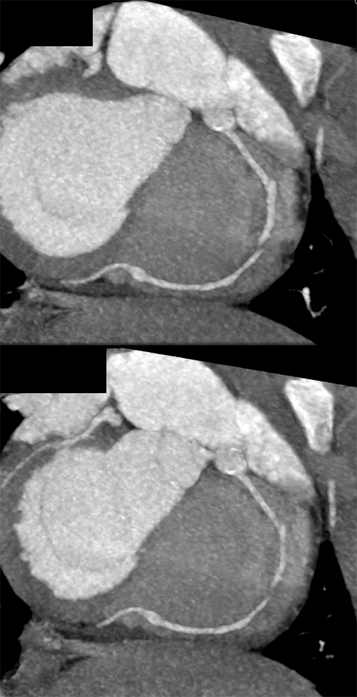 Kawasaki’s with Multiple Coronary Artery Aneurysms