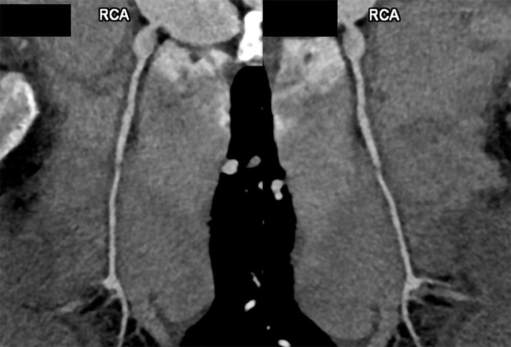 Kawasaki’s with Multiple Coronary Artery Aneurysms