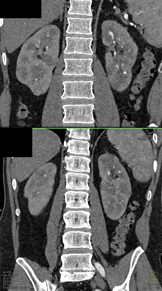 PAN with Multiple Aneurysms in Kidney, Mesenteric Vessels