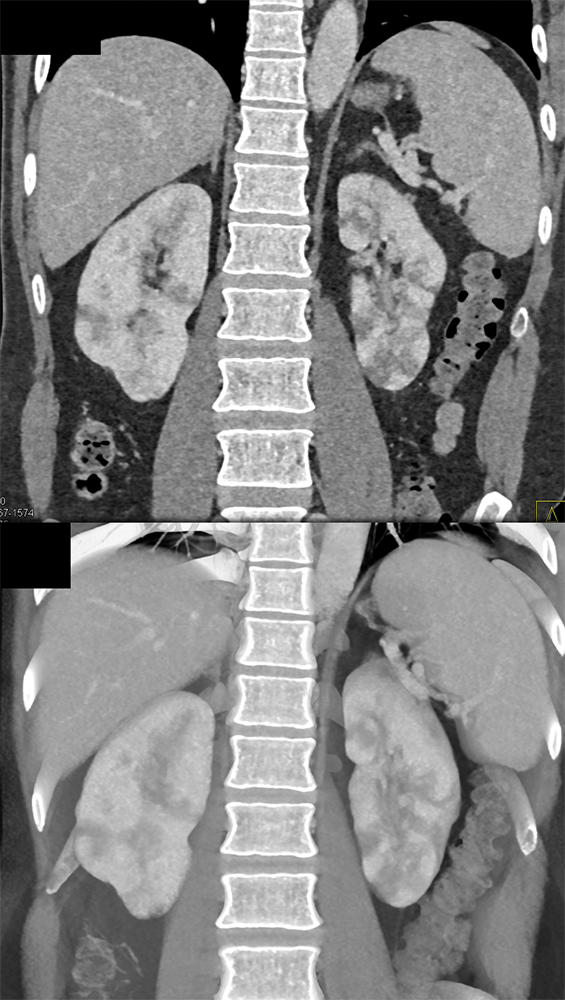 PAN with Multiple Aneurysms in Kidney, Mesenteric Vessels