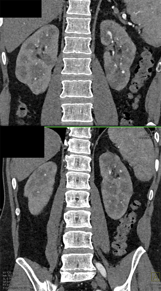 PAN (Polyarteritis Nodosa)