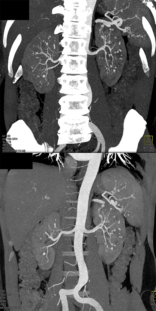 PAN (Polyarteritis Nodosa)