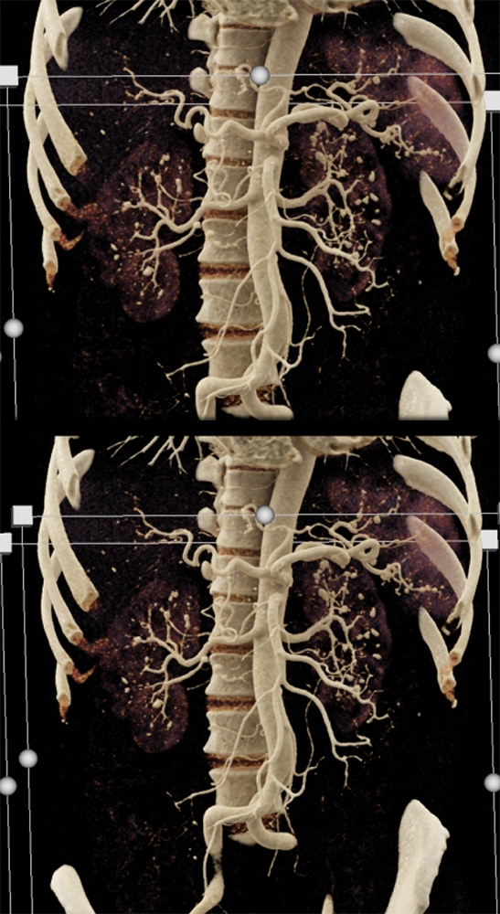 PAN (Polyarteritis Nodosa)