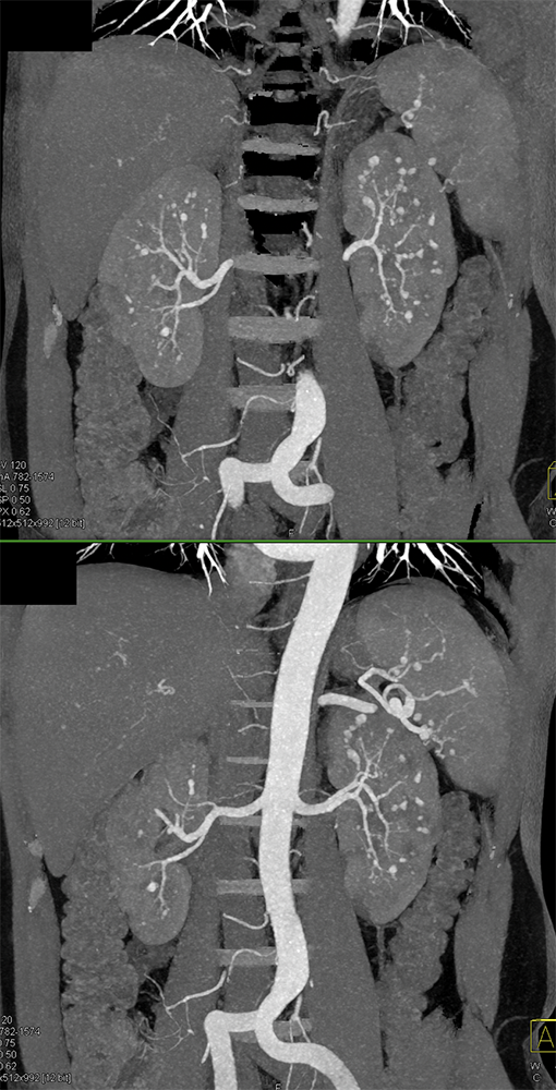 PAN (Polyarteritis Nodosa)