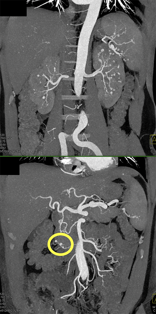 PAN (Polyarteritis Nodosa)