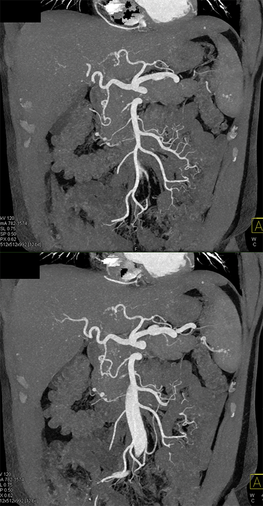 PAN (Polyarteritis Nodosa)